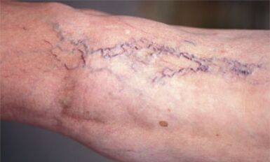 μέθοδοι θεραπείας των κιρσών στα πόδια