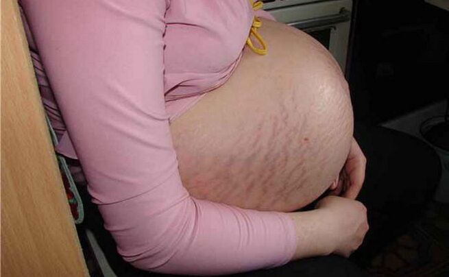 αιτίες κιρσών κατά τη διάρκεια της εγκυμοσύνης