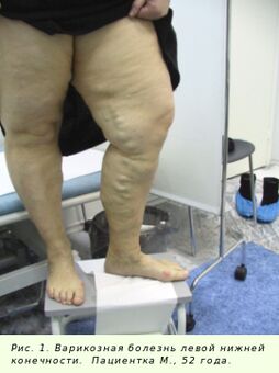 Οι κιρσοί πρέπει να αντιμετωπιστούν για να σταματήσει η διαδικασία