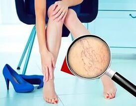 Τα συμπτώματα εξαρτώνται από τη φύση και το στάδιο των κιρσών