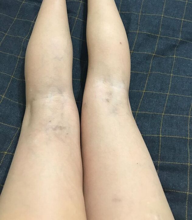 εκδηλώσεις κιρσών στα πόδια