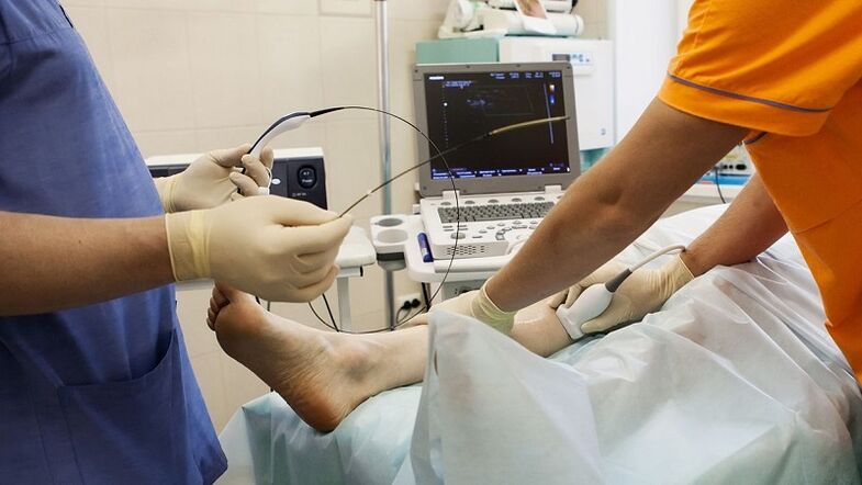 χειρουργική επέμβαση για την αφαίρεση κιρσών
